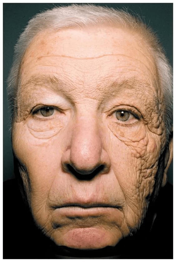 سمت راست صورت پوستی است که از ضد آفتاب استفاده نکرده و سمت چپ صورت پوستی است که از ضد آفتاب استفاده کرده است	